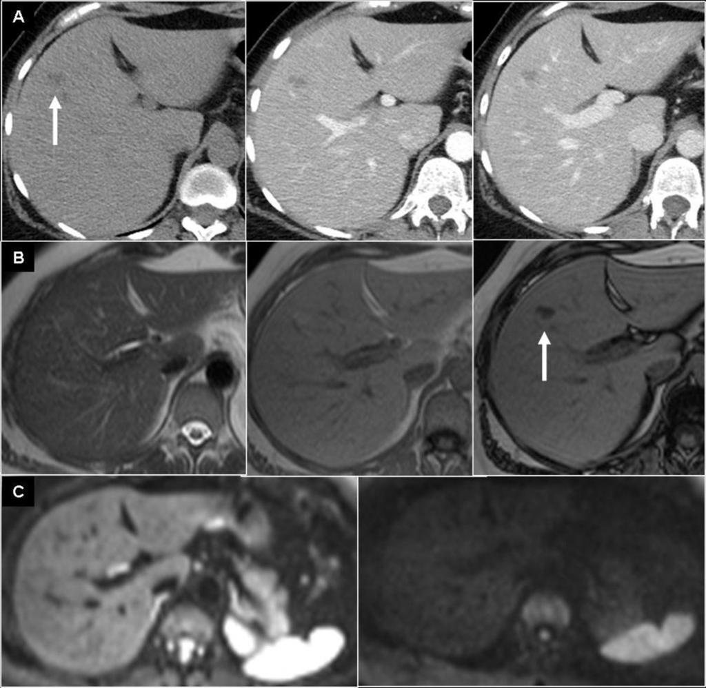 Fig. 6: Fig.6. 59 year old man. A. Multiple hypodense rounded nodules on CECT in a steatotic liver, simulating infiltrative metastatic disease.