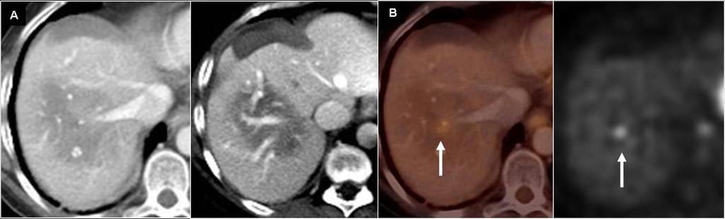 Fig. 8: Fig.8. 65 year old woman, history of colon CA, LM treated with RF ablation. A. CECT shows a vaguely bordered hypodense lesion in the right lobe.
