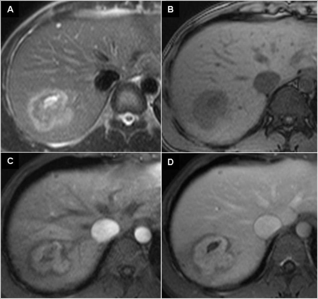 CT image: increased glucose metabolism in the lesion. C. Biopsy of the lesion showed focal granulomateous hepatitis with numerous eosinophils.