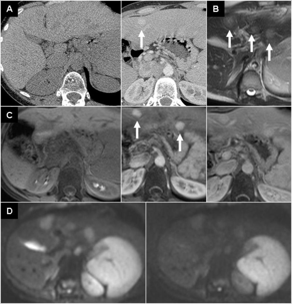 Fig. 17: Fig.20. 18 year old male, history of Ewing sarcoma and haemochromatosis. A. CE