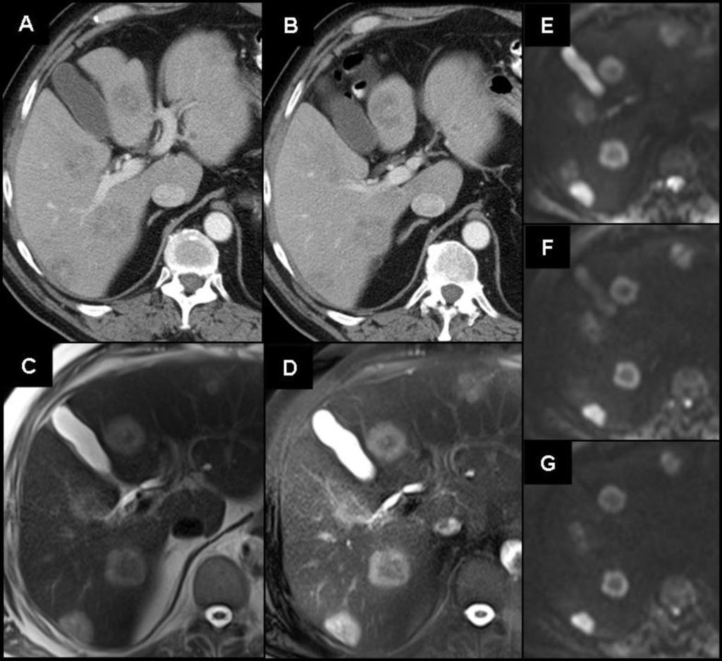 Fig. 1: Fig.1 65-year-old man, history of colorectal cancer with liver metastases.