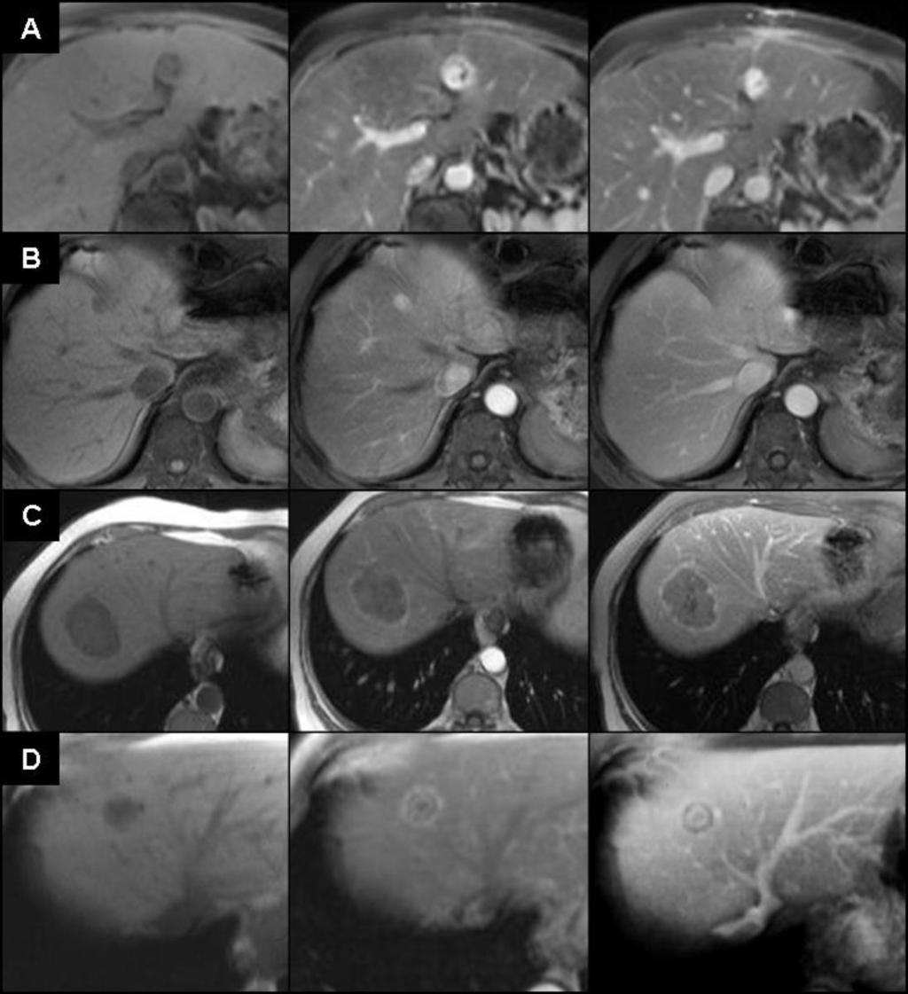 Fig. 2: Fig.2 CE pattern of metastases: A. Hypervascular nature with areas of necrosis in larger mets from a neuroendocrine tumor B.