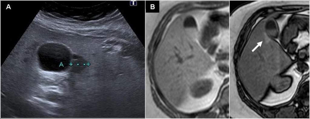 Fig. 3: Fig.3. 46 year old woman, history of breast cancer. A. Focal hypoechogenic nodule in a steatotic liver adjacent to the gallbladder. B-C.