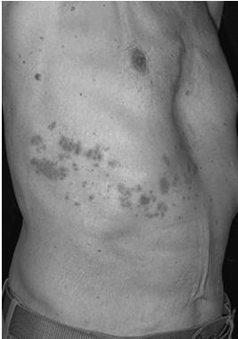 Varicella Mortality 1990-2001 Incidence decreased by 70% to 80% between 1995 and 2001 Mortality decreased by 66%: 0.41 to 0.