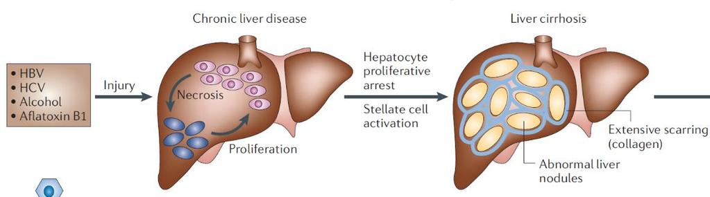 Liver Cancer Represents Significant Unmet Need Hepatocellular Carcinoma (HCC) Liver cancer is the 2nd leading cause of cancer death worldwide, and HCC is the most common form of this disease 16,000
