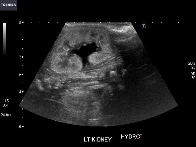 B/L Hydronephrosis renal impairment Accumulation of opioid