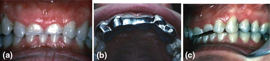 a Before surgery. b Immediately after surgery Fig. 2 a Localized anterior tooth wear. b Dahl appliance cemented in place.