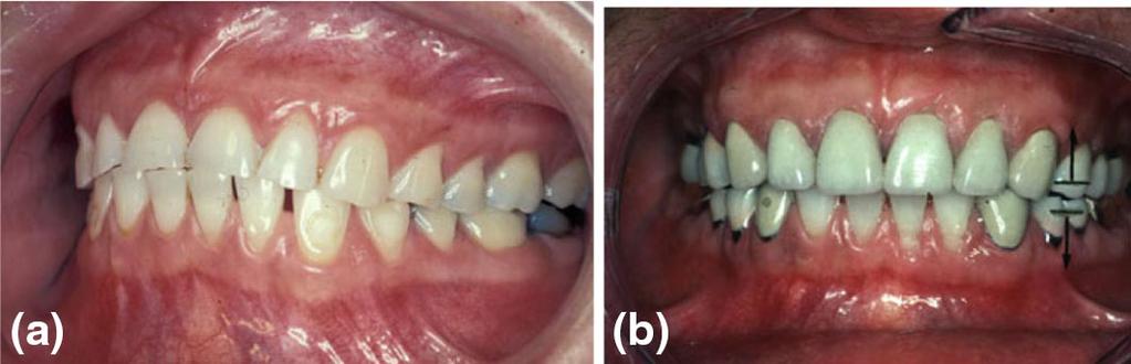 3 Generalized tooth wear restored with conventional crown restorations in the anterior and posterior segments at an overall increase in
