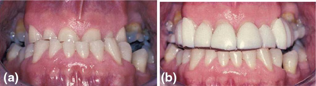4 Moderate/severe tooth wear with an unfavourable occlusal relationship initially restored with a provisional onlay/overlay removable