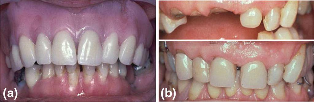 4 Page 6 of 11 Clin Dent Rev (2017) 1:4 Fig. 5 a Full labial flange. b Gingival fitting anterior tooth facings Fig.