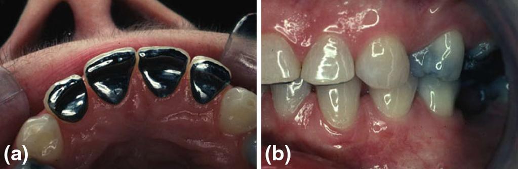 Clin Dent Rev (2017) 1:4 Page 7 of 11 4 Fig. 7 Nickel chromium alloy resin-bonded palatal veneers used to restore localized palatal tooth wear for maxillary incisor teeth. a Palatal view of veneers.