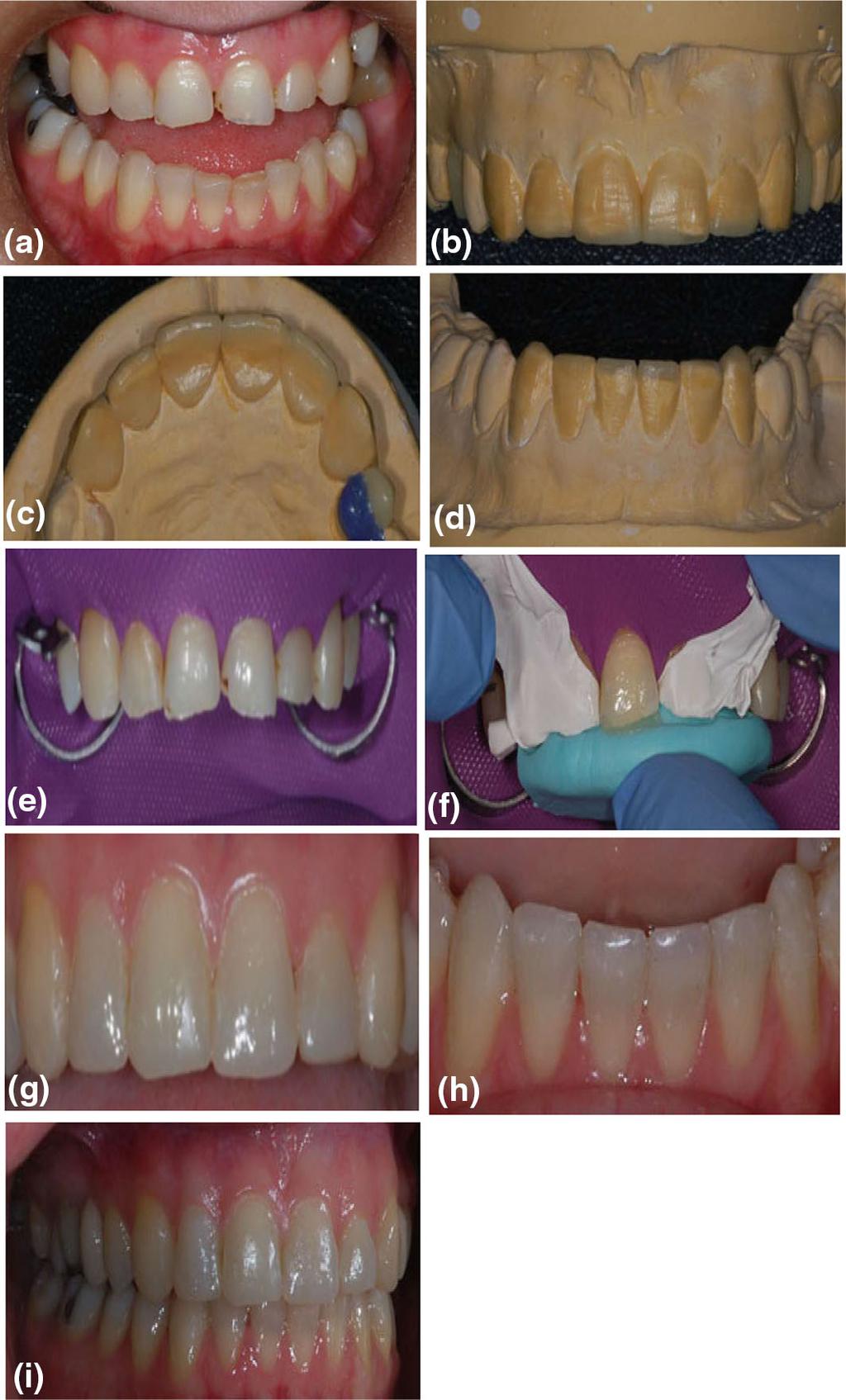 4 Page 8 of 11 Clin Dent Rev (2017) 1:4 Fig. 8 a i Restoration of worn upper and lower anterior teeth with direct composite resin restorations. a Before restoration.