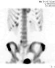 Scan Osteoid Osteoma Spondylolysis