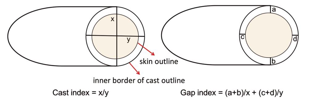x= Distance between inner border of the plaster/cast at the fracture/moulding site in lateral view. y= Distance between inner border of the plaster/cast at the fracture/moulding site in AP view.