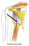 Control external bleeding and immobilize the upper are from the shoulder to