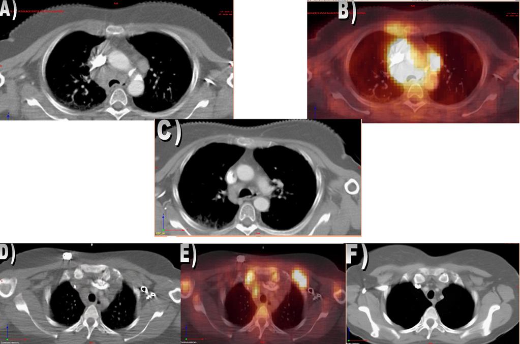 T. Girinsky et al. / Radiotherapy and Oncology 88 (2008) 202 210 205 Fig. 4. (A) An obvious involvement of the mediastinum on a prechemotherapy CT scan.