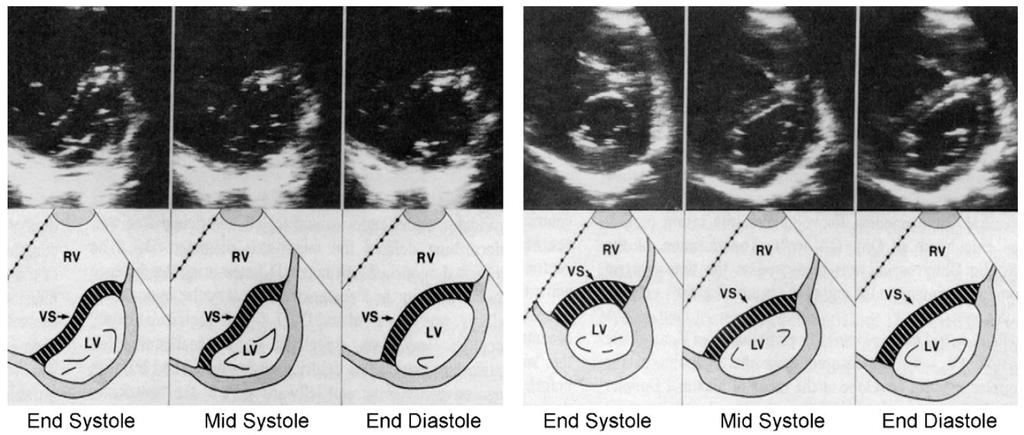 Echocardiographic Assessment of the Right Heart RV Pressure Overload (Pulmonary Arterial Hypertension RV Volume Overload (Isolated TR) Volume overload RV dilatation Paradoxical septal movement RV