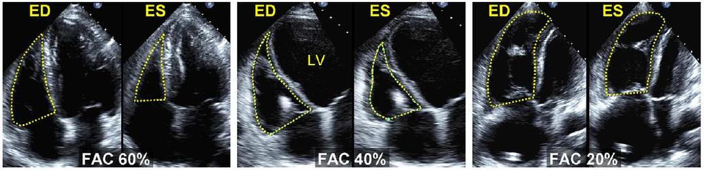 Echocardiography: RV Function RV Fractional Area Change (FAC) FAC = 100 x