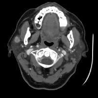neck with contrast MRI with contrast FNAC Management: