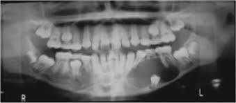 decades Mandible ( most common) Painless, slowly