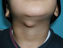 mass, sinus ( URTI) Dx: U/S neck