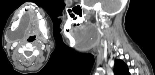 CT,MRI neck Management : Excision of