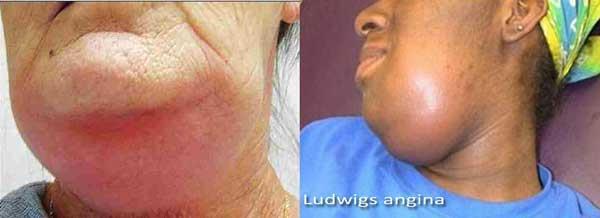 Neck mass/infectious Ludwig's angina Age : adult Recent odontogenic