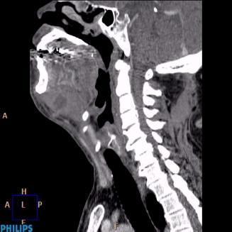 airway obstruction Dx: Clinical exam CT scan neck ( contrast) Management :