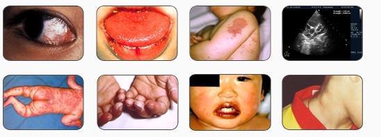 Neck mass Kawasaki syndrome Age : childhood Fever, rash, conjunctivitis, dry red lip & Strawberry tongue Cervical lymphadenopathy