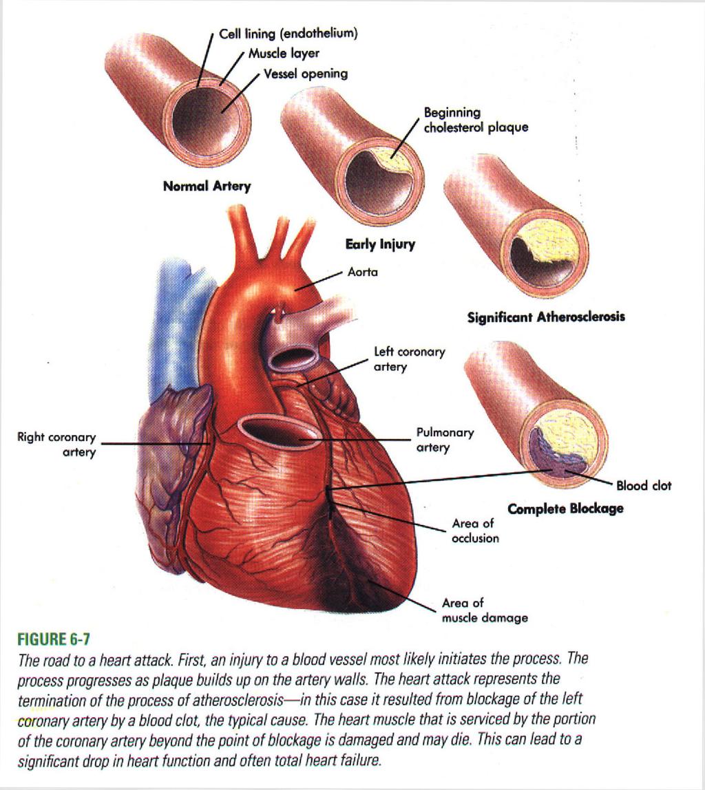 Atherosclerosis - hardening of the arteries by plaque deposits.