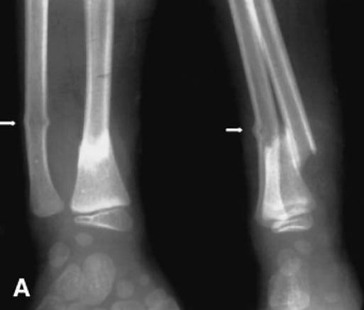 Fracture of distal