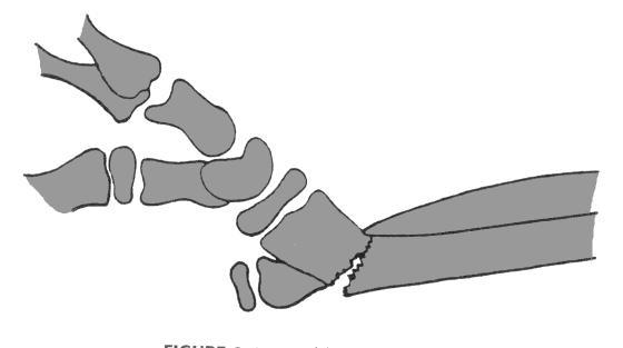 Distal Radius Fractures Galeazzi fractures Radius fx with dislocation of distal R-U joint