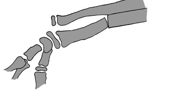 injury CR: pronation + wrist flexion Apex-dorsal fx - with dorsal dislocation of ulna -