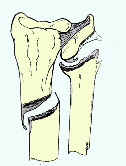 distal ulnar physeal injury -- more