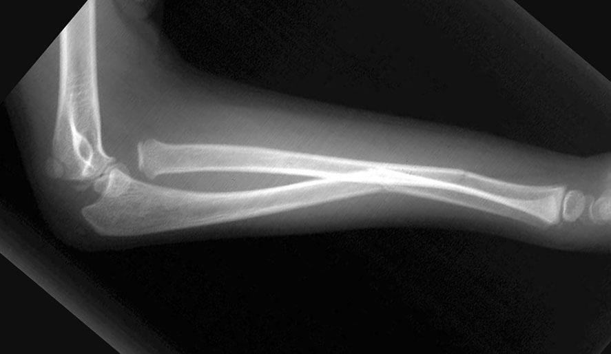 Proximal forearm fractures Monteggia fractures a fracture of the ulna