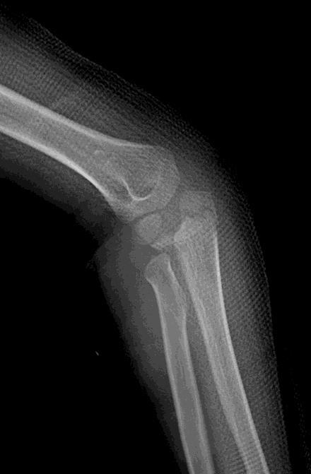 Proximal forearm fractures