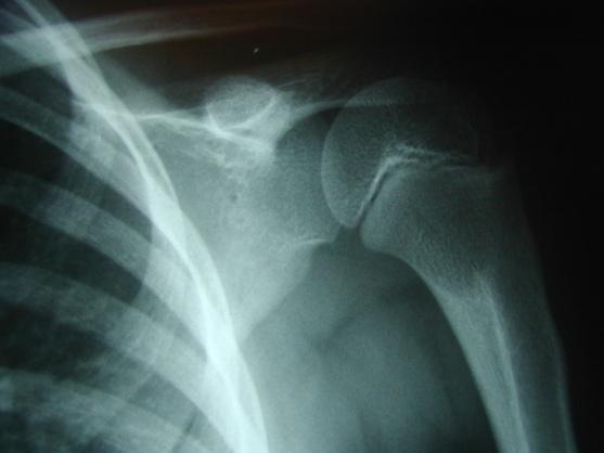 Proximal humerus fractures Conservative
