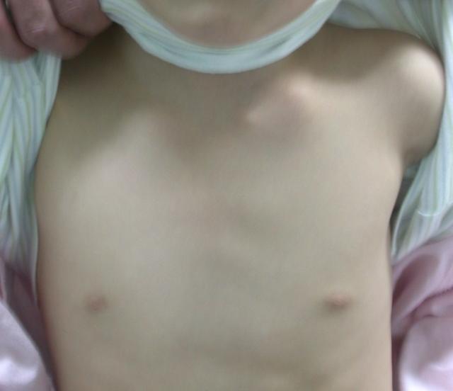 Clavicle fractures Common fx in children Usually