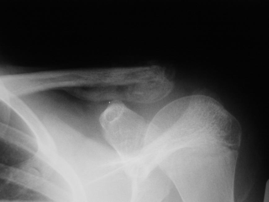 Clavicle fractures Distal clavicle fx