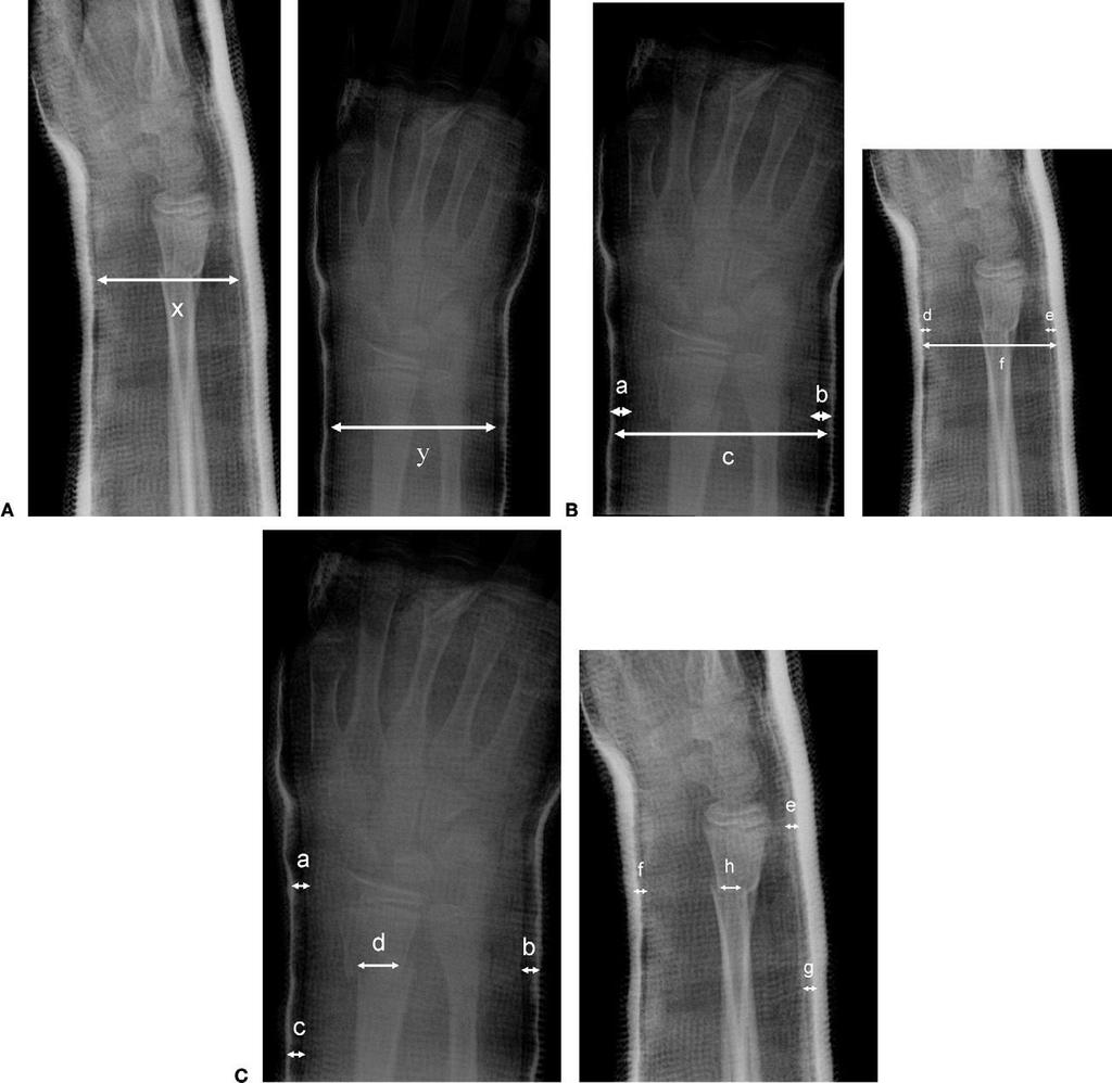 Fracture of