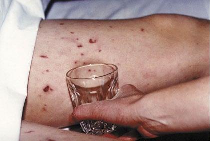 The meningococcal rash The rash starts as a cluster of pinprick blood spots under the skin, spreading to form bruises.