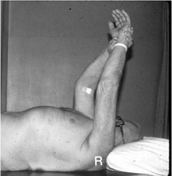Shoulder: Exam -Impingement Hawkins sign: - Sensitivity: 75% - Specificity: 45% Painful arc of motion: - forward elevation 90 + internal rotation Park, et al, JBJS 2005 Rotator Cuff Disease: