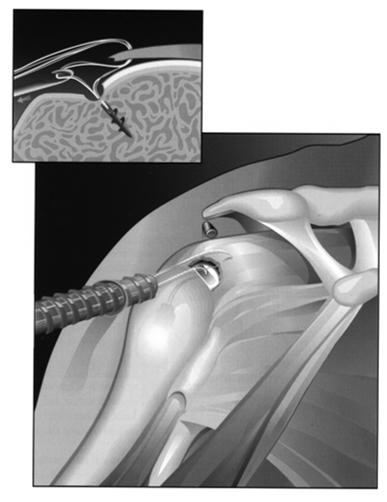 Weakness after trauma Suggests rotator cuff tear MRI!! Surgery Case 3 Rotator Cuff Repair Open Surgical Repair - Repair to Bone - Full Recovery-Months!