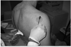 Surgery Suzuki, et al, J Am Acad Orthop Surg 2014 SUBACROMIAL - Accuracy: 80-90% Glenohumeral AC