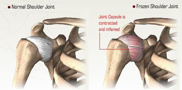 Introduction - Frozen Shoulder Frozen Shoulder Unit 2: Frozen Shoulder Frozen shoulder, also called adhesive capsulitis is a condition characterized by pain and loss of motion in shoulder joint.