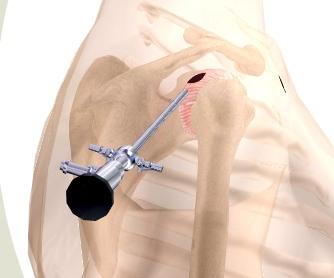 10) In an arthroscopic procedure, two or three small incisions are made. Each incision is called a portal.