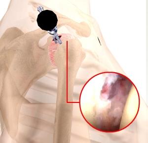Along with the arthroscope, a sterile solution is pumped to the joint which expands the shoulder joint, giving the surgeon a