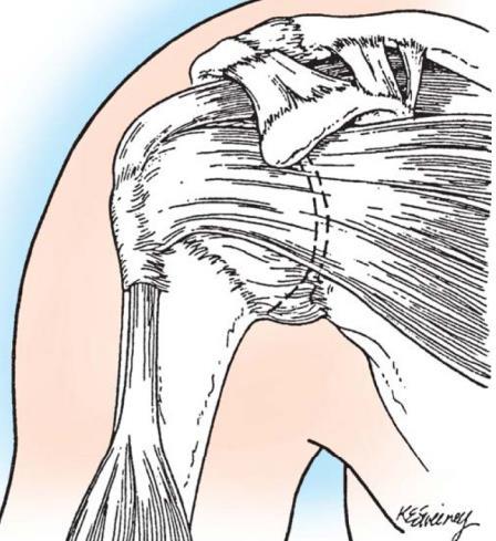Neer : Definition Impingement on the tendinous portion of the rotator cuff by the coracoacromial ligament and the anterior third of the acromion JBJS Vol. 54-A, pp.