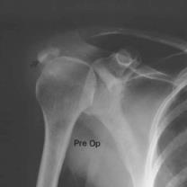 mm) between the humeral