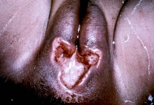 Cutaneous Amebiasis intestinal or hepatic fistula mucosa bathed in fluids